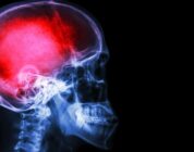Some traumatic brain injuries linked to increased risk of brain cancer
